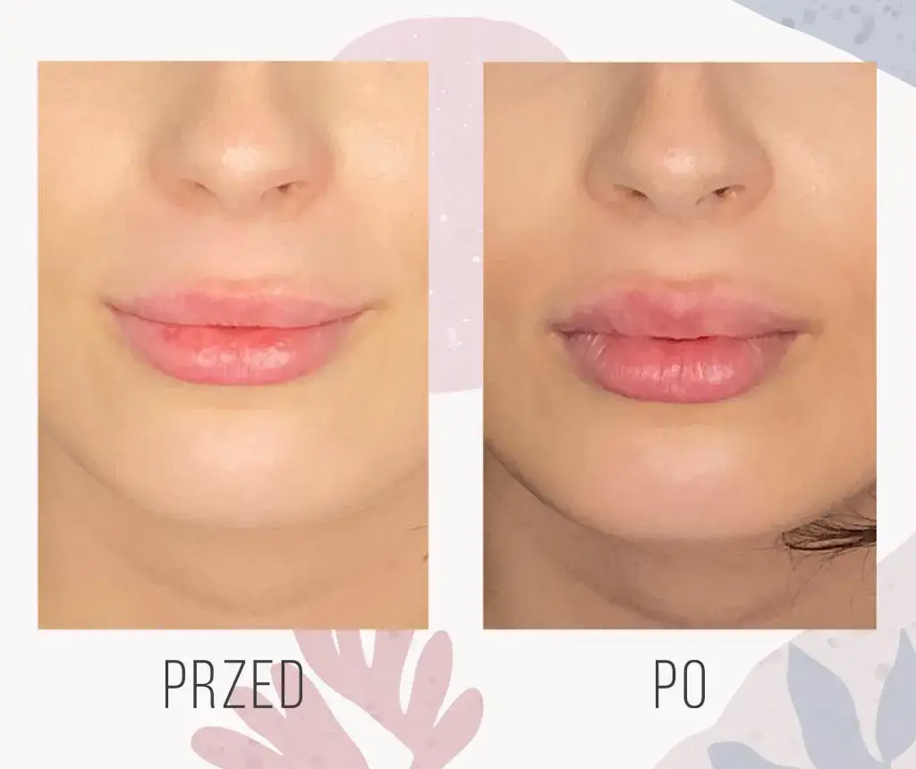 rodzaje ust przed i po kwas hialuronowy