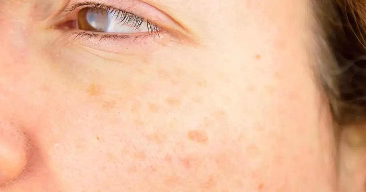 Zbliżenie na twarz z widocznymi przebarwieniami, które mogą być oznaką problemów z wątrobą.
