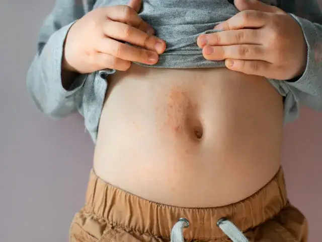 objawy alergii pokarmowej niemowlę brzuszek