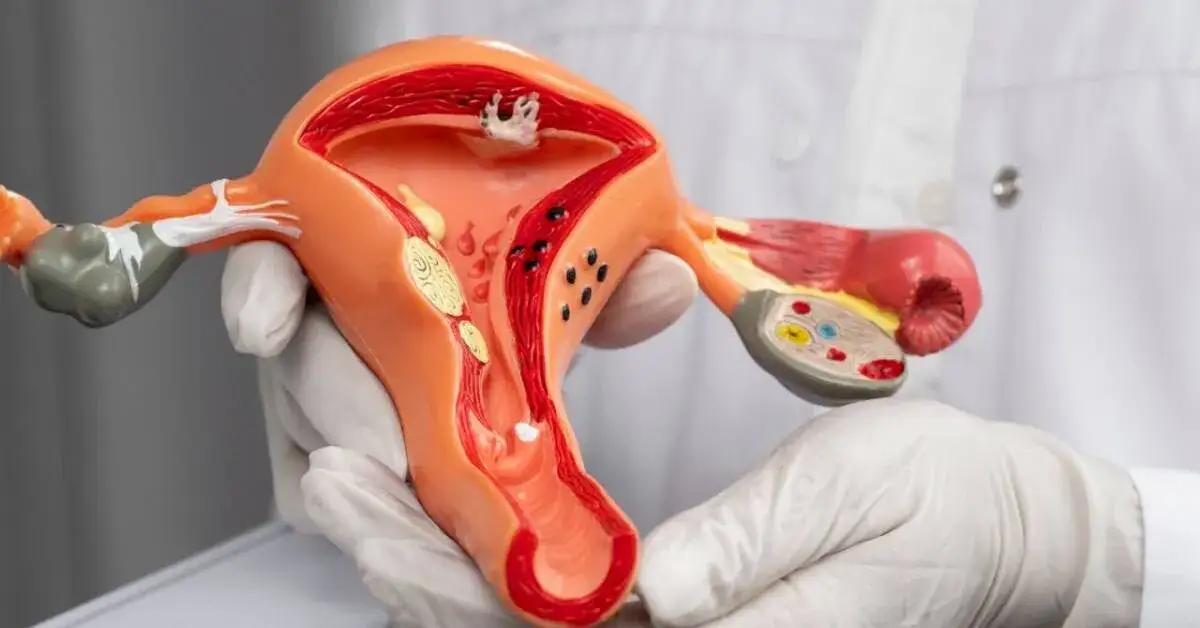 mięśniaki macicy polipy endometrioza