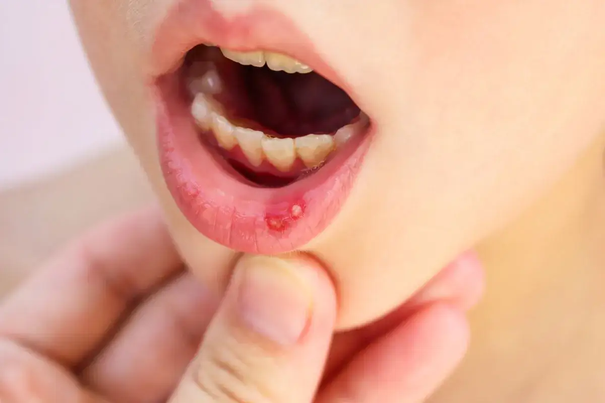 Dziecko ma otwarte usta, widoczne są ząbki i czerwone, bolące pęcherzyki na wardze, objawy wirusowego zapalenia dziąseł.