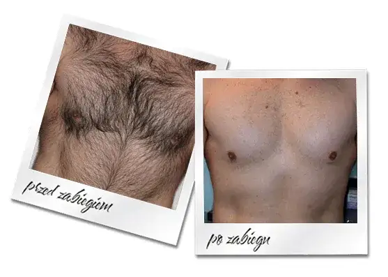 cennik depilacji laserowej Białystok