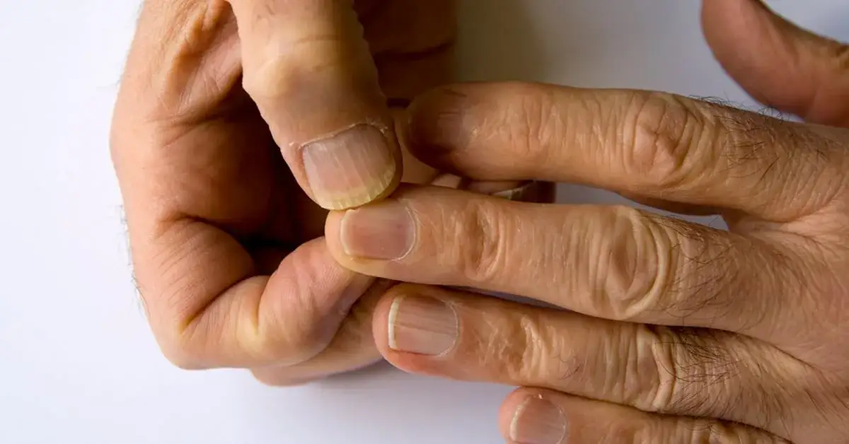 pielęgnacja palca po utracie paznokcia instrukcja