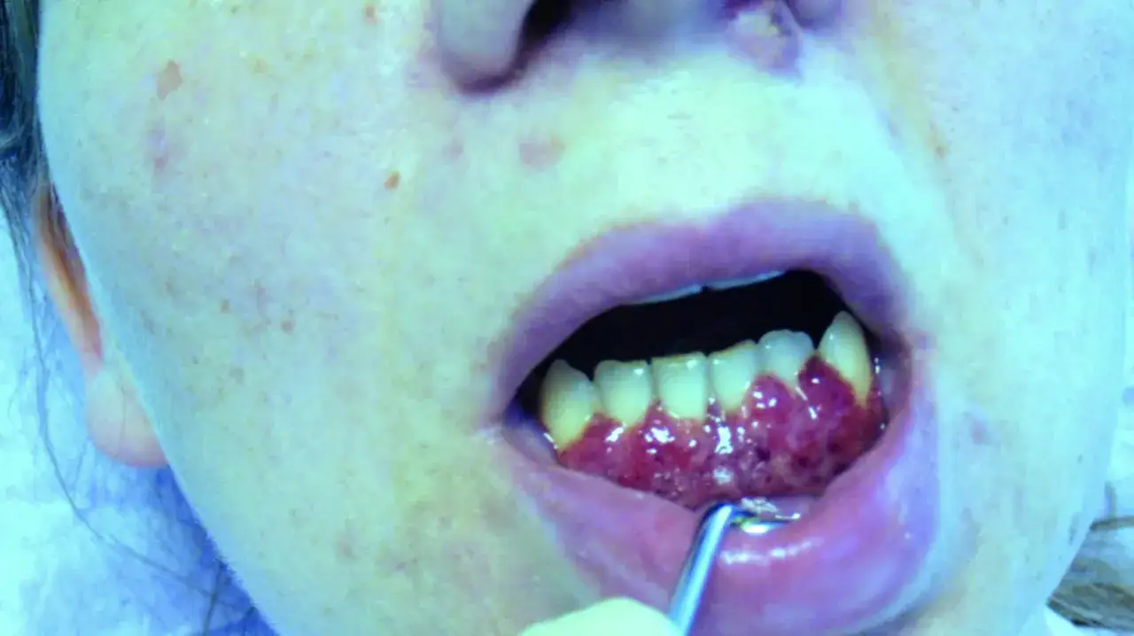 Widoczne objawy białaczki w jamie ustnej: zaczerwienione, opuchnięte dziąsła z wybroczynami.