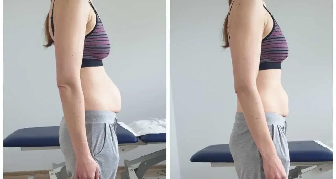 rozejście mięśnia prostego brzucha po ciąży