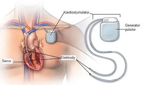 chirurg wymieniający rozrusznik serca