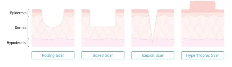 Rodzaje blizn potrądzikowych infografika