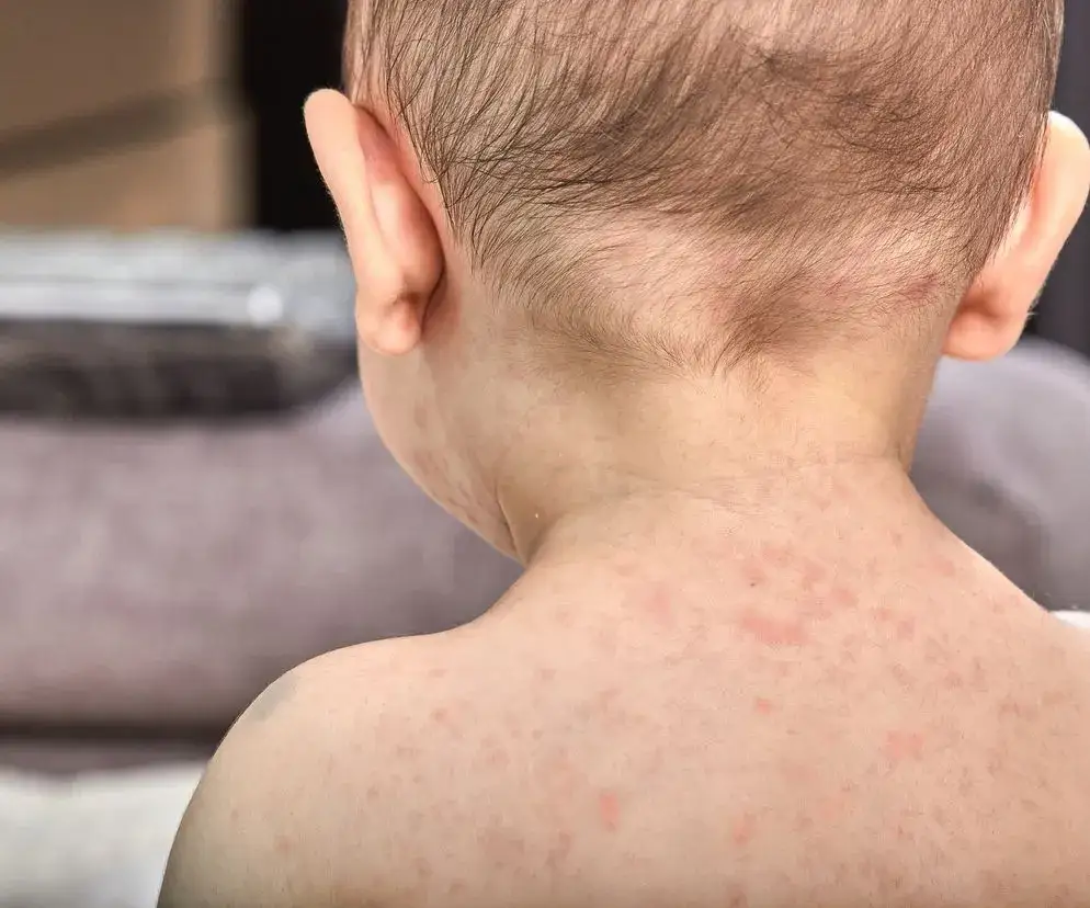 dziecko gorączka wysypka lekarz