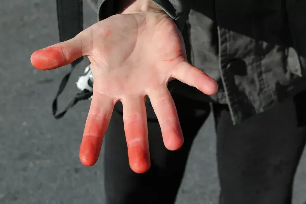 Stopnie odmrożeń objawy zdjęcia