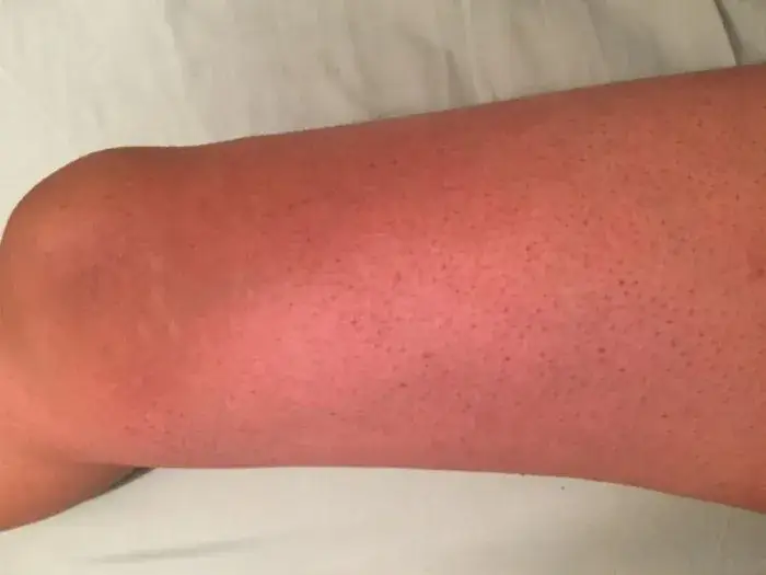 Zdjęcie Czerwone kropki po goleniu nóg - dlaczego się pojawiają i jak ich uniknąć