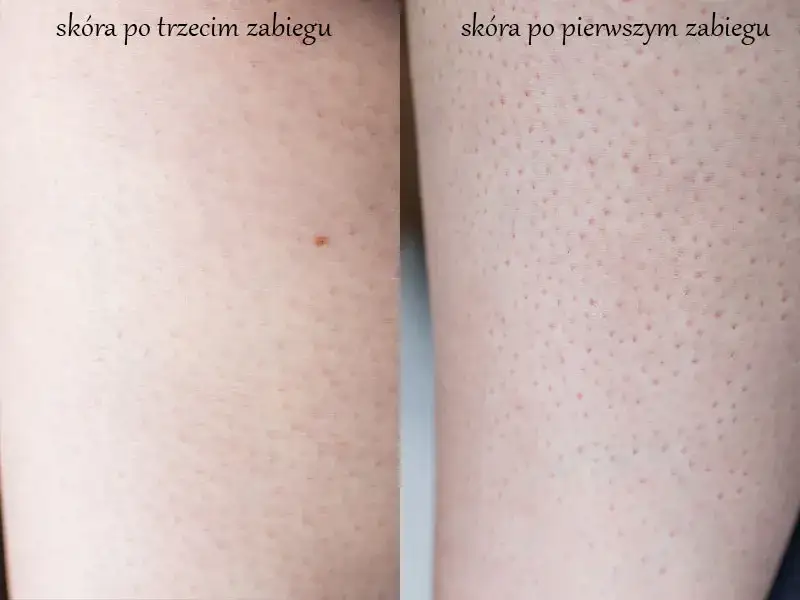 depilacja laserowa nóg efekty po serii zabiegów