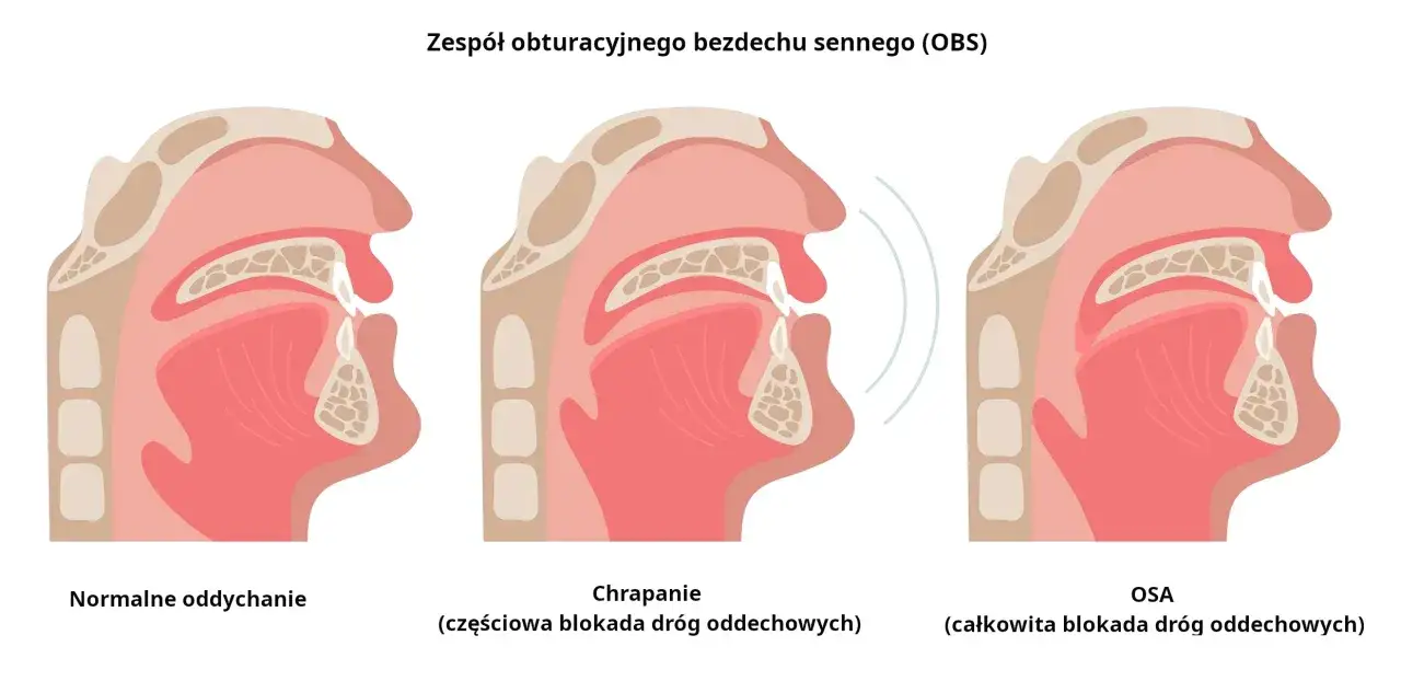 Ilustracja pokazuje przekrój gardła przy normalnym oddychaniu, chrapaniu (częściowa blokada) i bezdechu sennym (OSA - całkowita blokada). Domowe sposoby na bezdech senny mogą pomóc.