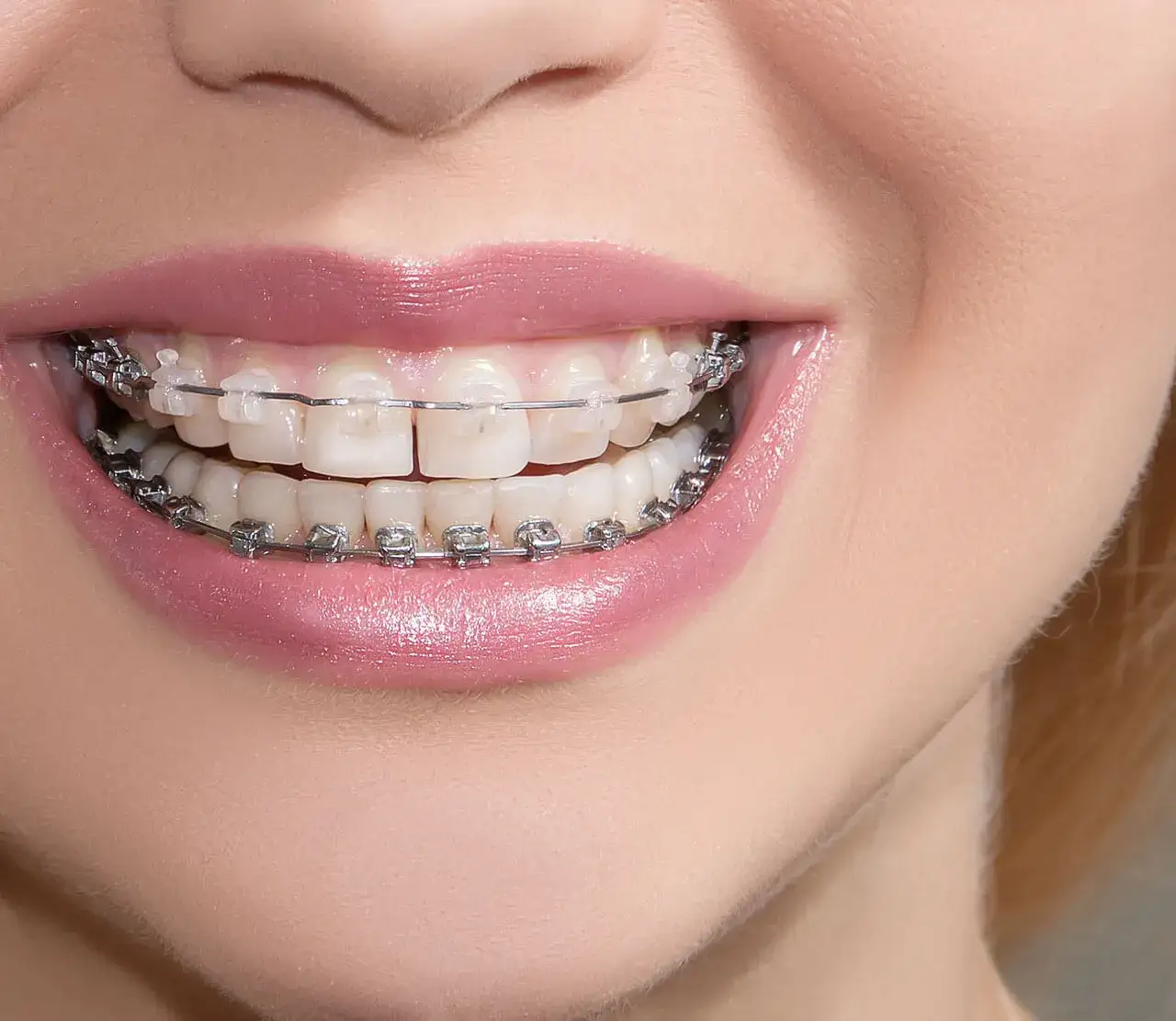 implant zębowy a aparat ortodontyczny