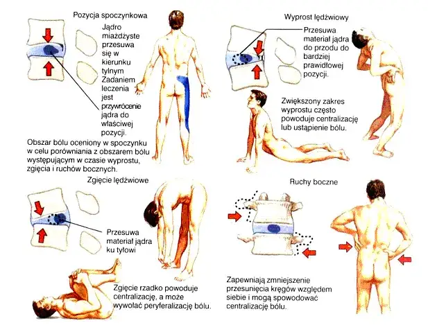 metoda McKenziego ćwiczenia na kręgosłup