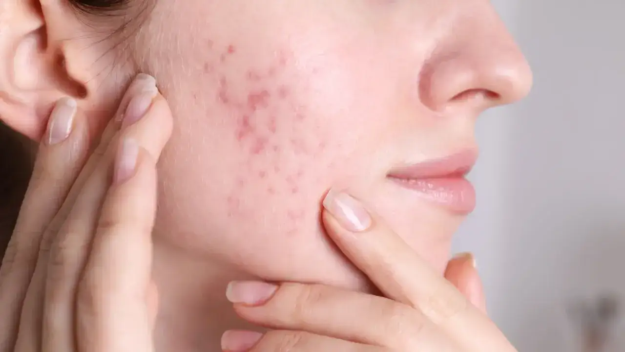 składniki aktywne na trądzik