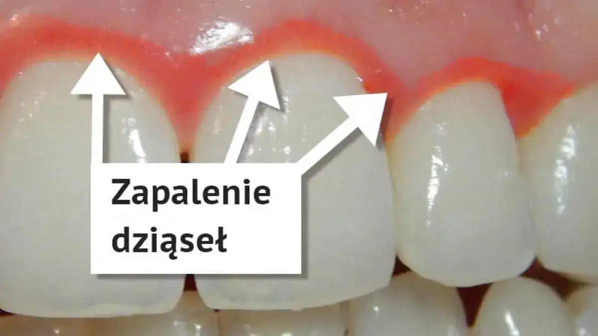 Zdjęcie Od czego bolą dziąsła? Poznaj przyczyny i skuteczne metody leczenia