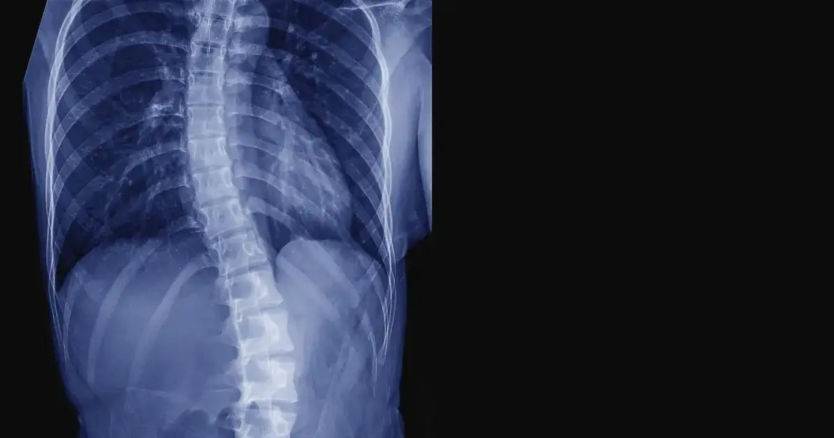 Zdjęcie Skolioza lewostronna objawy: jak je rozpoznać i uniknąć powikłań
