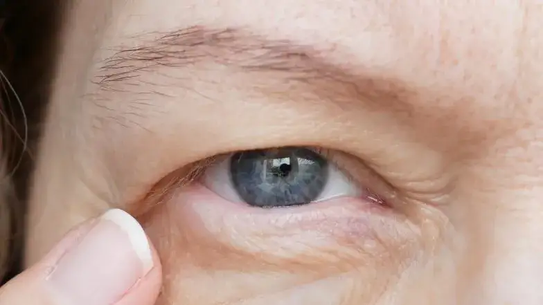 Zdjęcie Opadająca powieka przyczyny neurologiczne: poznaj groźne symptomy