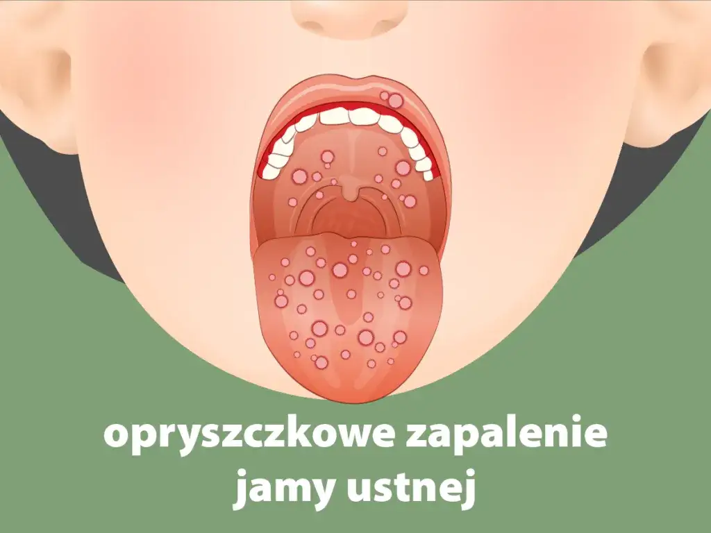 Zapalenie jamy ustnej u dziecka objawy