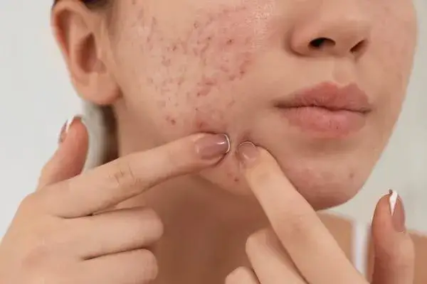 blizny po wyciskaniu pryszczy, konsekwencje wyciskania trądziku