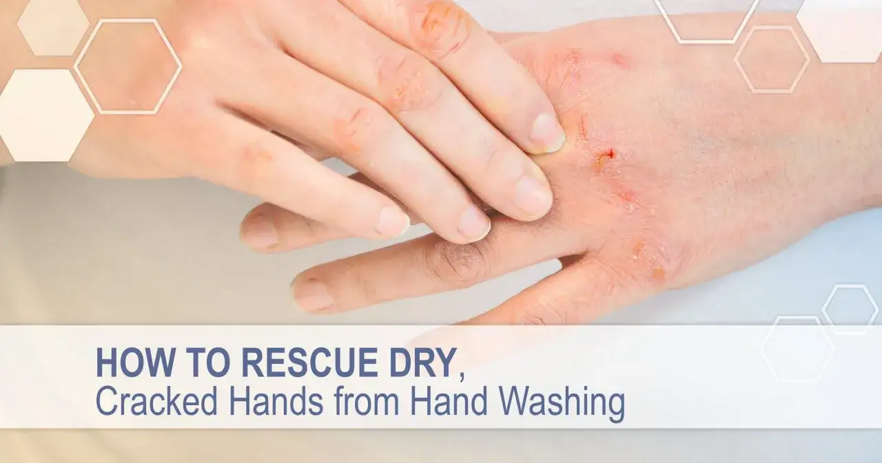 Pękająca sk&oacute;ra dłoni z ranami, oznaka przesuszenia i podrażnienia.