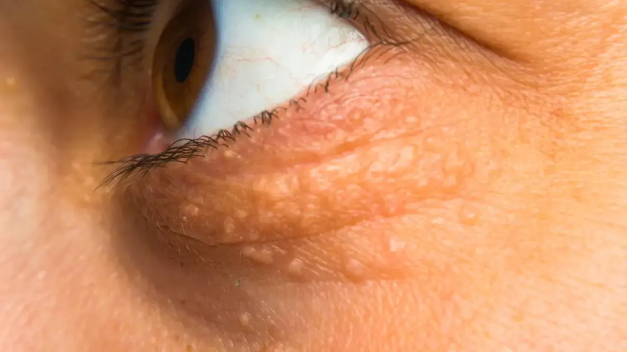 Zbliżenie na oko z widocznymi żółtymi plamami na twarzy, które mogą być objawem problemów skórnych.