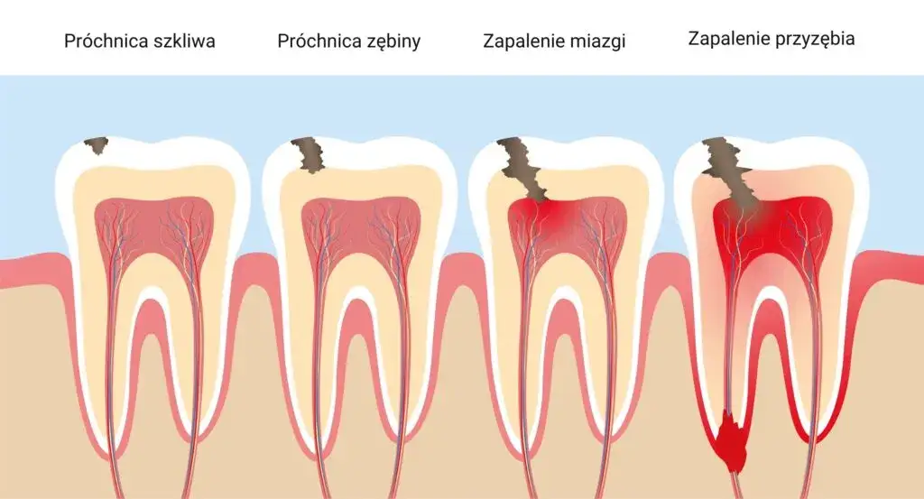 przyczyny bólu zęba grafika