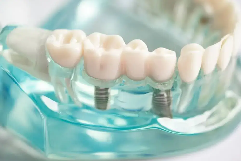 implant zęba a naturalny ząb por&oacute;wnanie estetyka