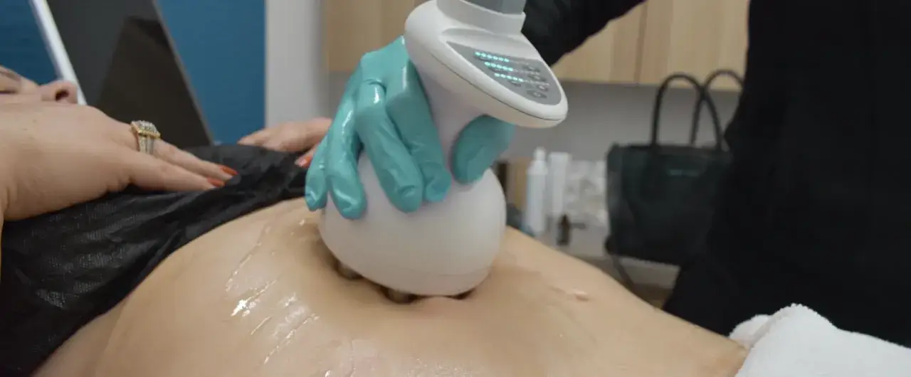 Zabieg kosmetyczny, kt&oacute;ry pomaga jak się pozbyć cellulitu. Ręka w rękawiczce trzyma urządzenie do masażu sk&oacute;ry.