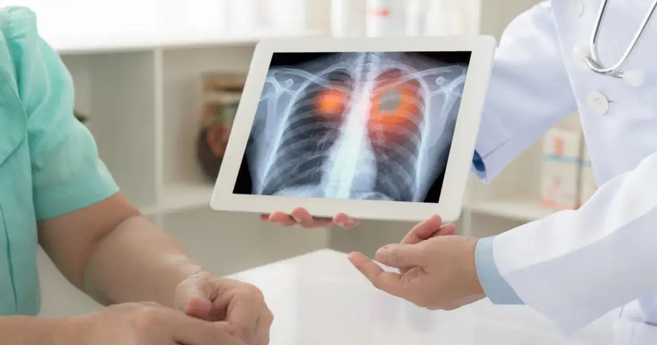 Lekarz pokazuje pacjentowi zdjęcie RTG płuc z zaznaczonymi zmianami. Czy odma płucna czy można umrzeć?