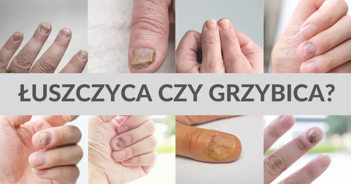 Różne rodzaje grzybicy skóry i paznokci
