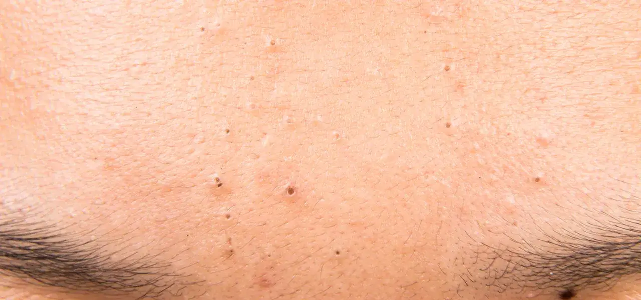 zapchana cera objawy zask&oacute;rniki otwarte zamknięte