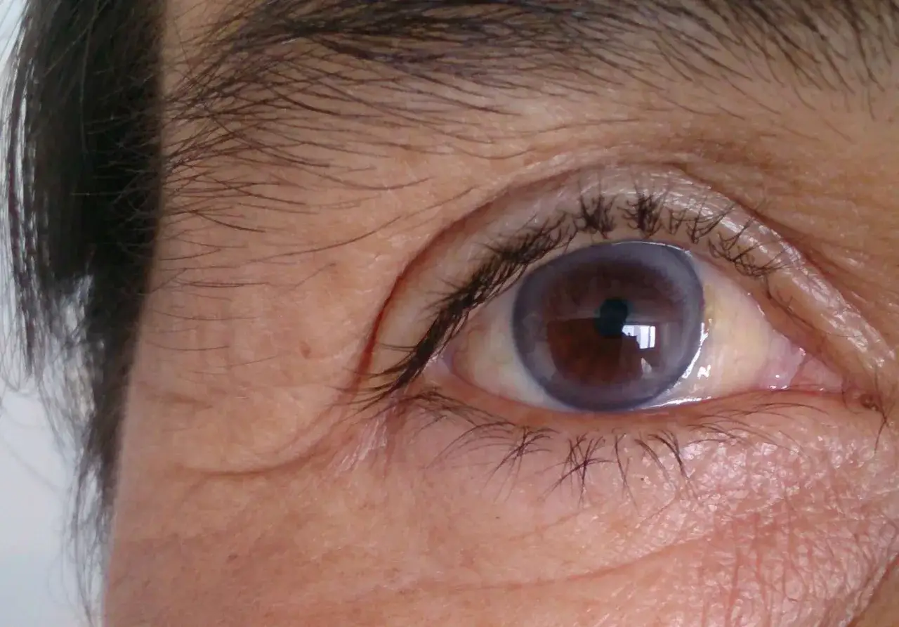 Oko z centralną heterochromią, gdzie tęcz&oacute;wka ma brązowe centrum otoczone niebieskawą obw&oacute;dką.