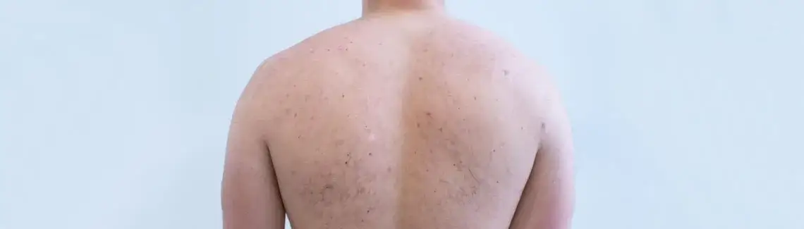 dermatolog leczenie trądziku na plecach