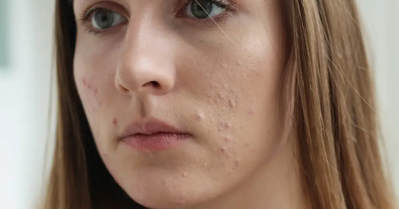 Sudocrem na pryszcze przed i po