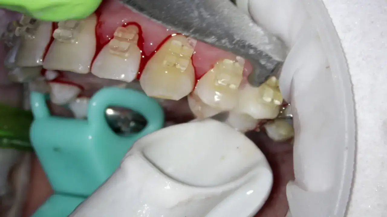 skaling piaskowanie zęb&oacute;w dentysta
