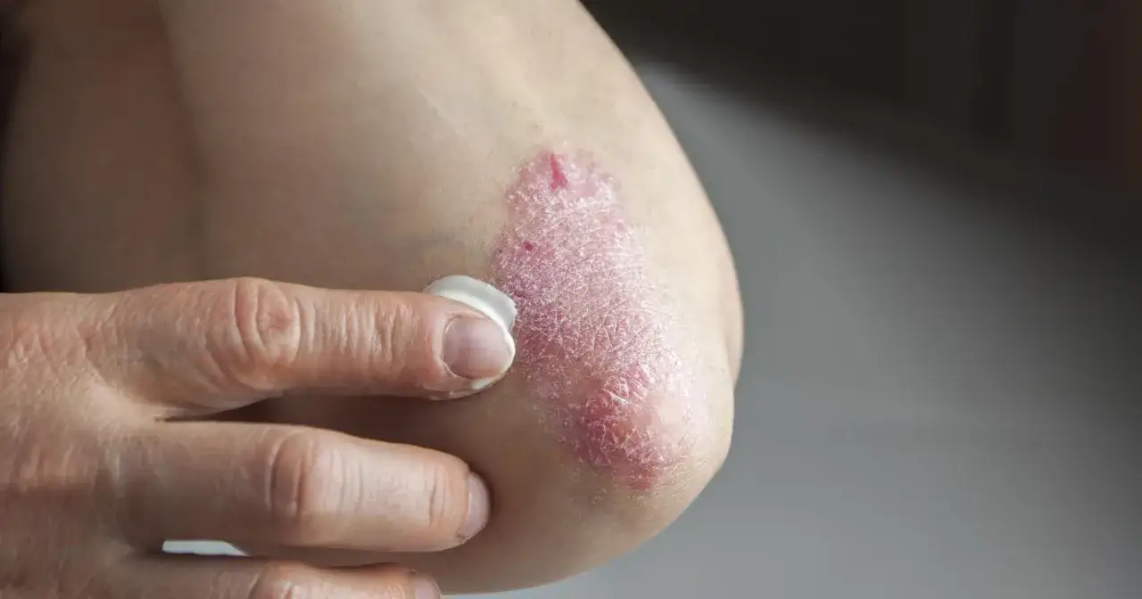 Dłoń nakłada krem na łokieć z łuszczycą, gdzie widoczne są czerwone, łuszczące się zmiany i białe kropki na skórze.