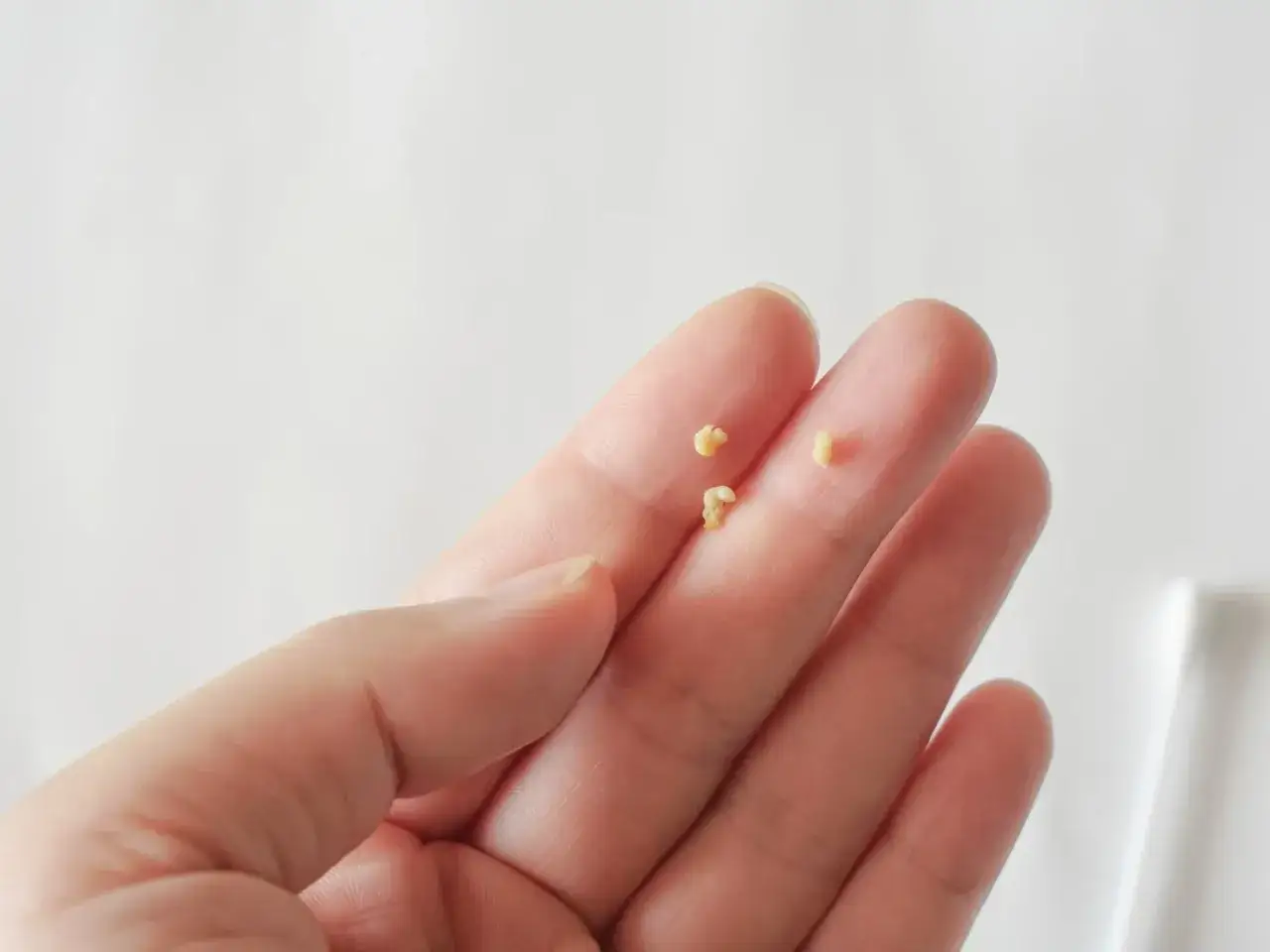 Małe, ż&oacute;łtawe kamienie migdałkowe na palcu. Czy kamienie migdałkowe są groźne? Zwykle nie, ale mogą powodować nieświeży oddech.