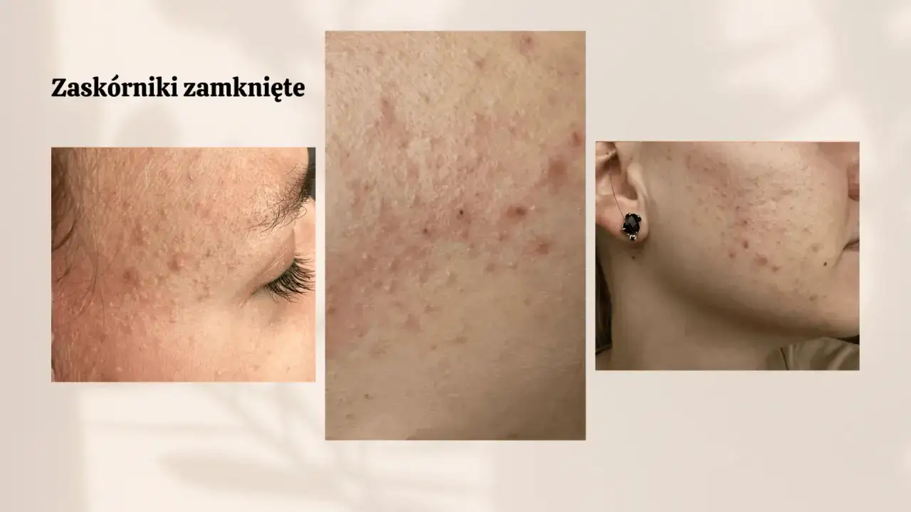 Zbliżenia skóry pokazujące zapchane pory, drobne wypryski i zaczerwienienia.