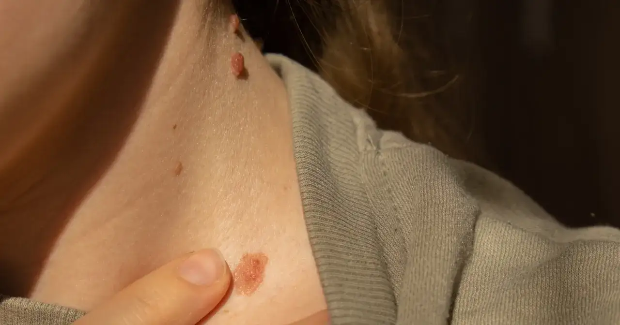 Na pieprzyku może zrobic się pryszcz, jak widać na szyi z kilkoma znamionami i jednym zaczerwienionym.