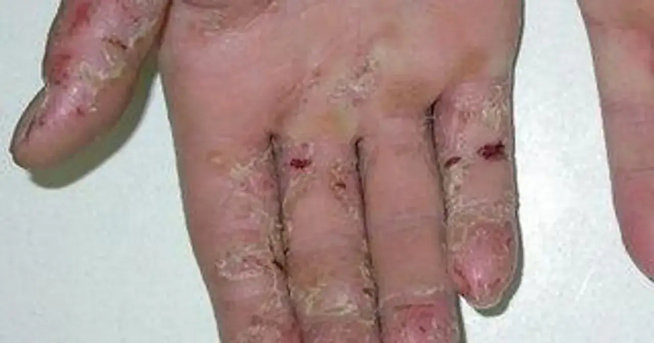 Dłoń z widocznymi objawami chorób skóry: suchość, pęknięcia, zaczerwienienie i łuszczenie naskórka, szczególnie na palcach.