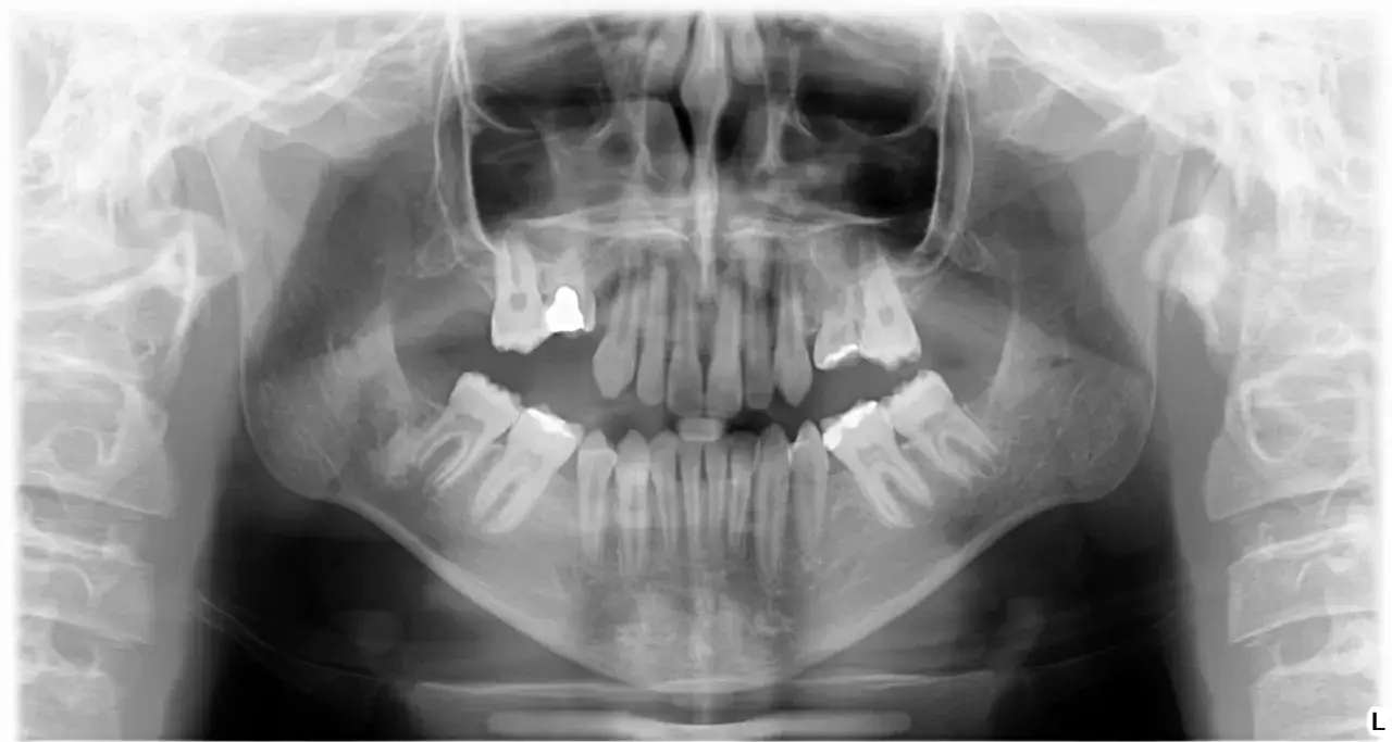 RTG szczęki pokazuje zęby trzonowe, niekt&oacute;re z wypełnieniami. Nie widać oznak, że zęby trzonowe wypadają.