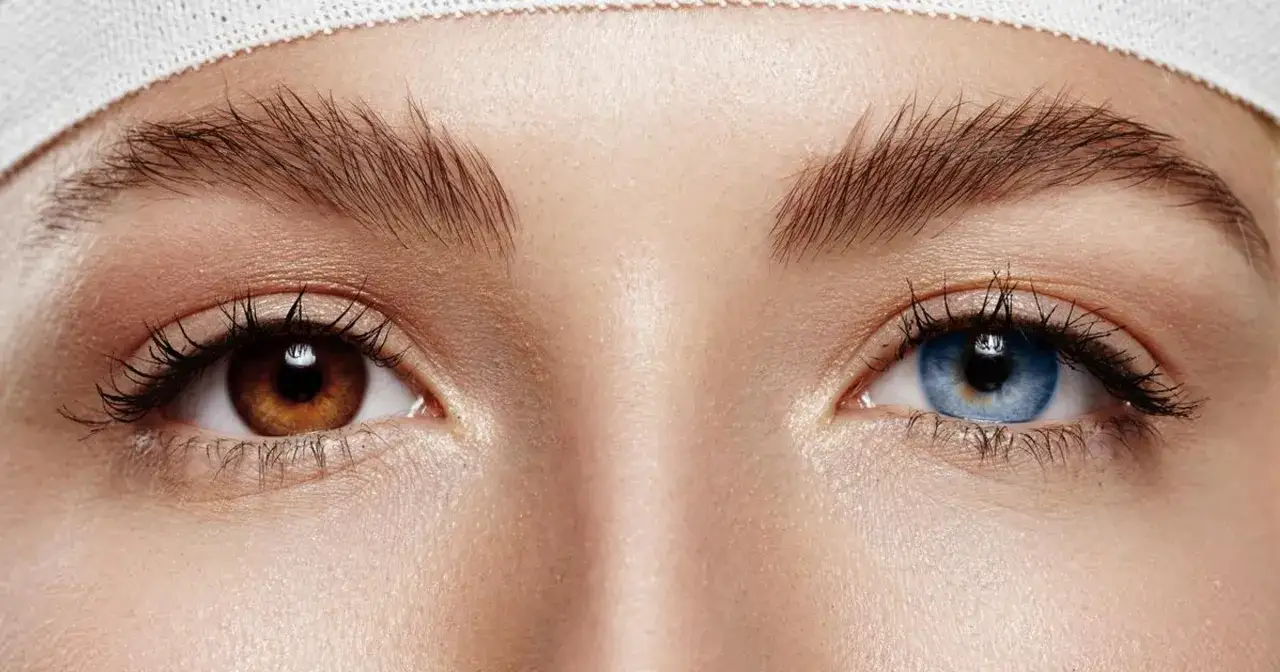 Oczy o r&oacute;żnych kolorach &ndash; jedno brązowe, drugie niebieskie &ndash; to przykład heterochromii.