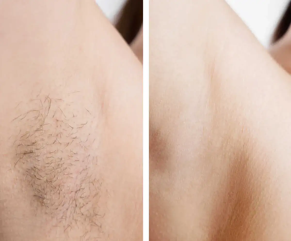 depilacja laserowa efekty przed i po