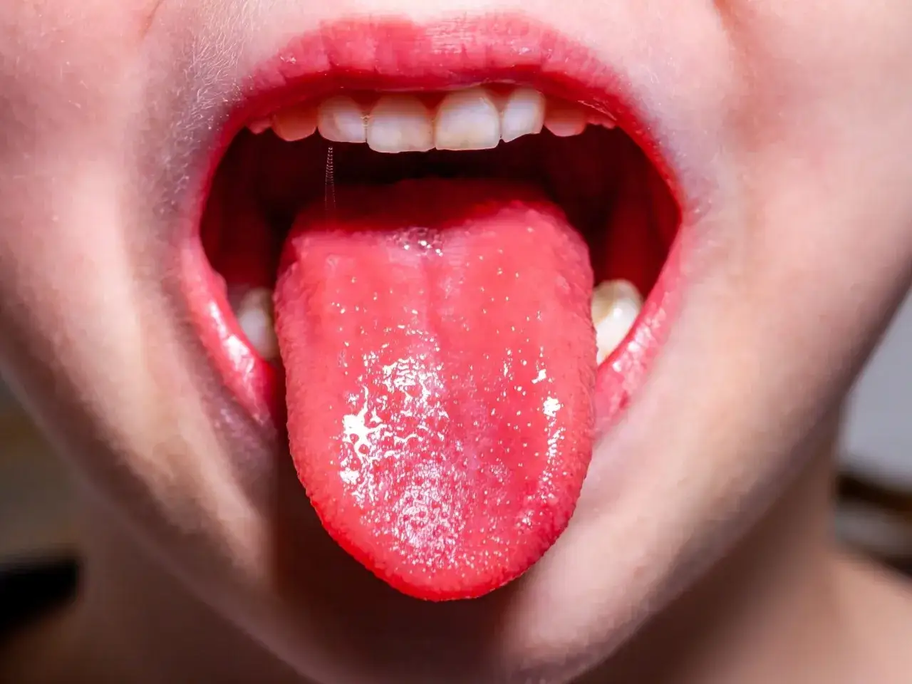 Zdjęcie Szkarlatyna w przedszkolu - kiedy można wysłać dziecko?