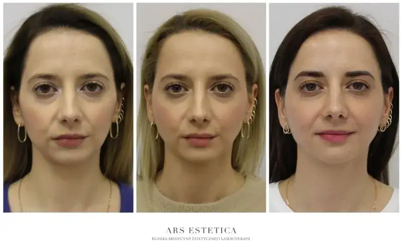 Zdjęcie Skuteczne zabiegi rozjaśniające cienie pod oczami - efekty i metody