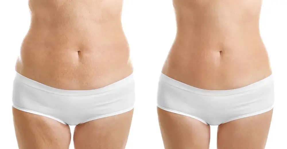 Zdjęcie Liposukcja kawitacyjna czy lipolaser: która metoda przynosi lepsze efekty?