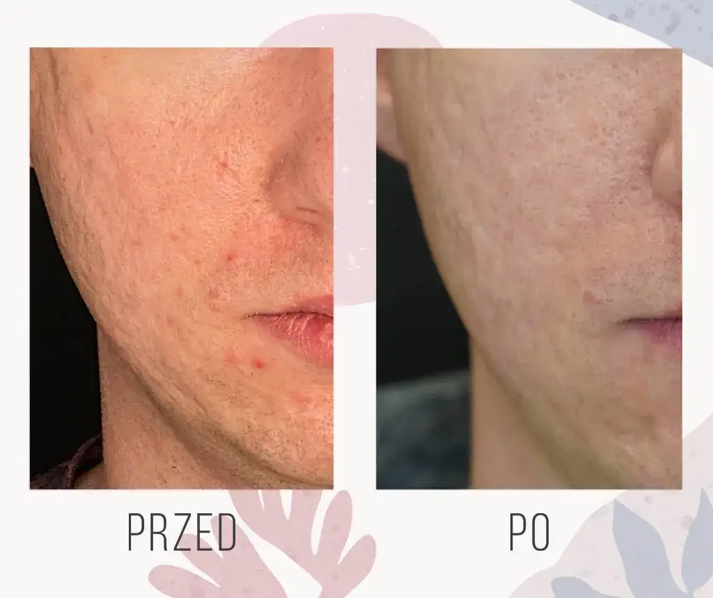 zabiegi laserowe na przebarwienia pozapalne