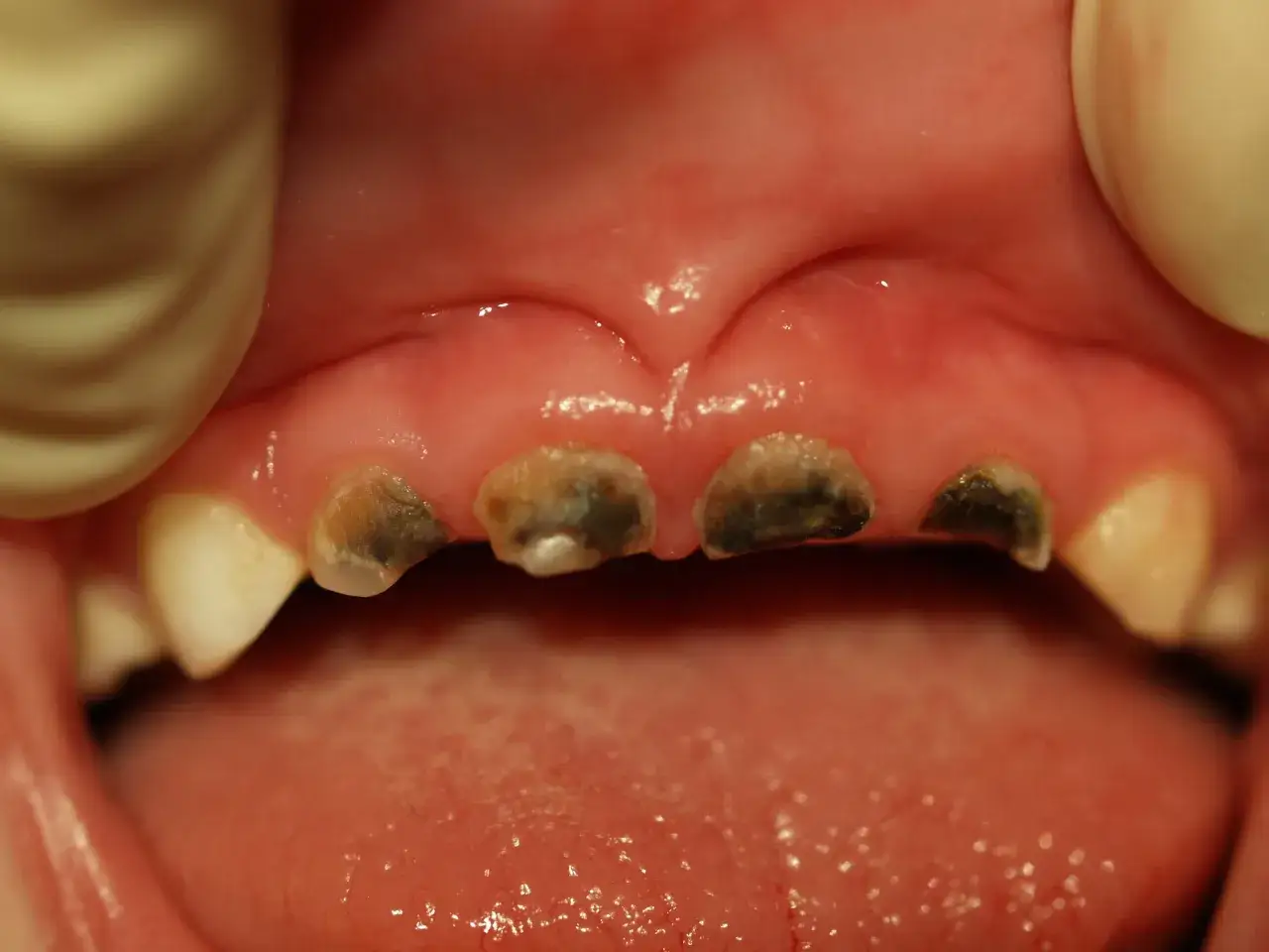 Widoczne są mocno zniszczone, czarne zęby dzieci, z widocznymi ubytkami i próchnicą.