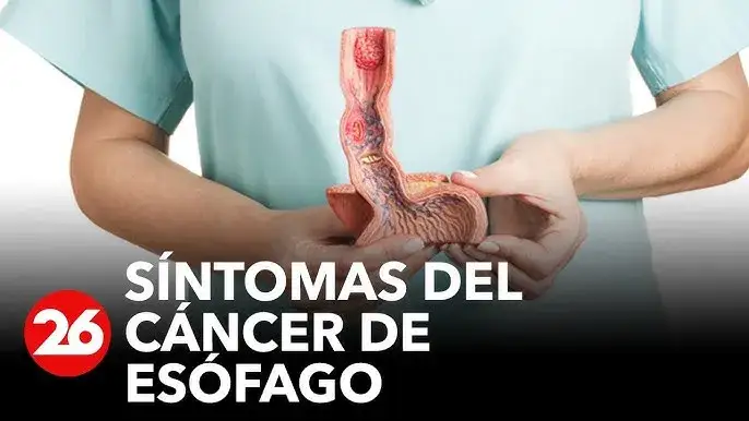 Zdjęcie Cáncer de esófago: síntomas clave que no debes ignorar. ¿Los conoces?